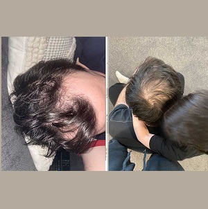 Hair Transplant Melbourne